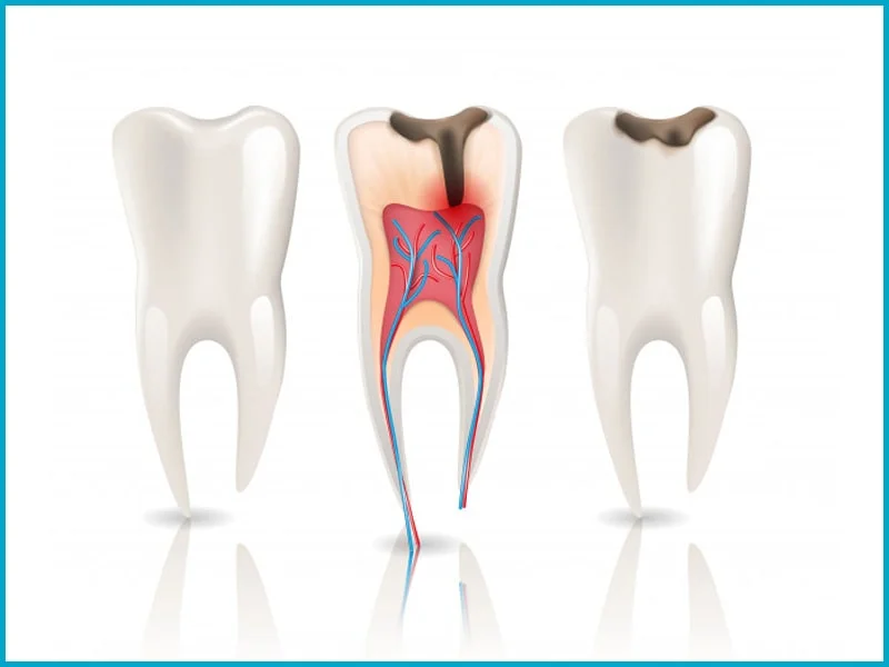 Root Canal Treatment